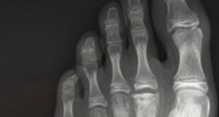 imagen de una radiografia de un pie