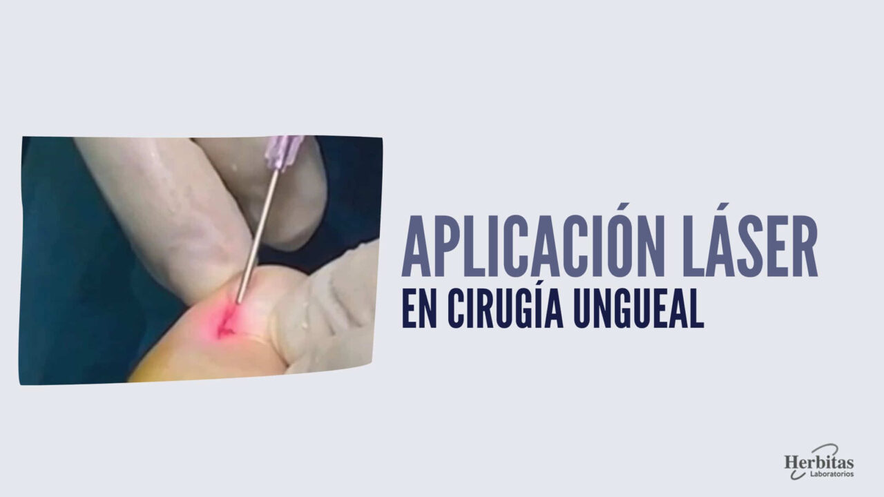 Aplicación Láser en cirugia ungueal - BLOG HERBITAS