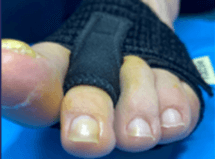 sinovitis metatarsofalangica tratada con Fixtoe