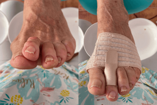 heloma dorsal con Fixtoe